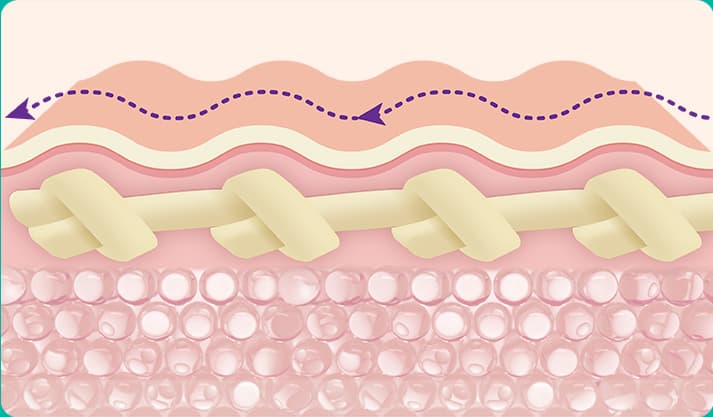 Vaginal Implant