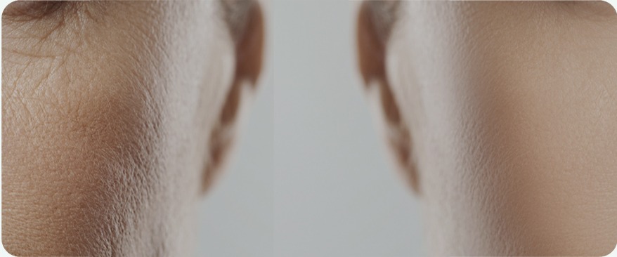 Customized 1:1 Treatment with Collagen Volume Design image