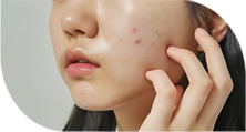 Pores/Scars