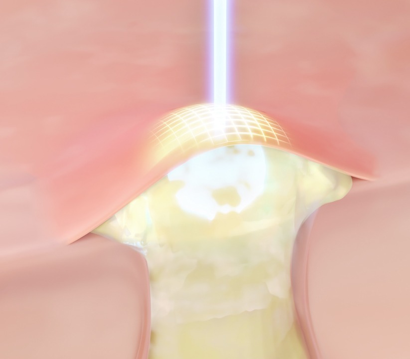 AFL Laser Benefits