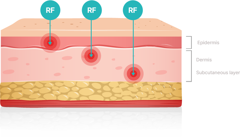 rf image 1