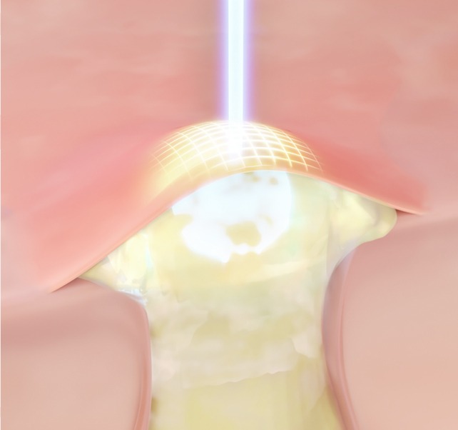 A+ Laser image